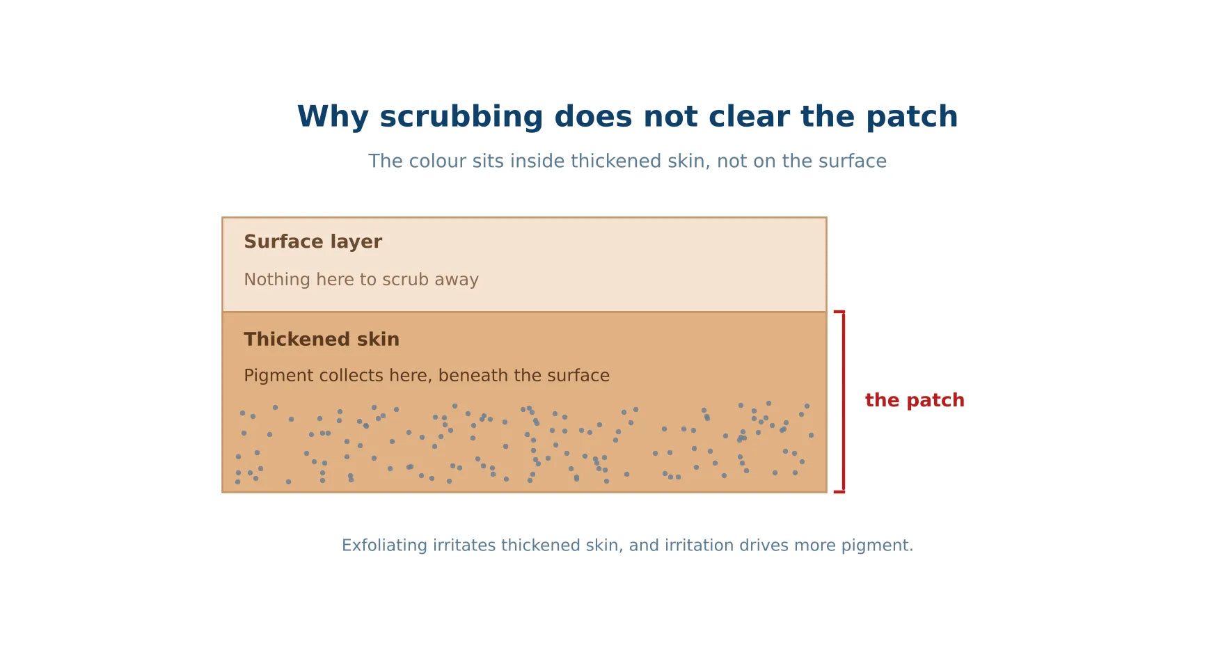 Cross-section of skin showing that the dark colour sits inside the thickened layer beneath the surface, labelled to show there is nothing on the surface for scrubbing to remove.
